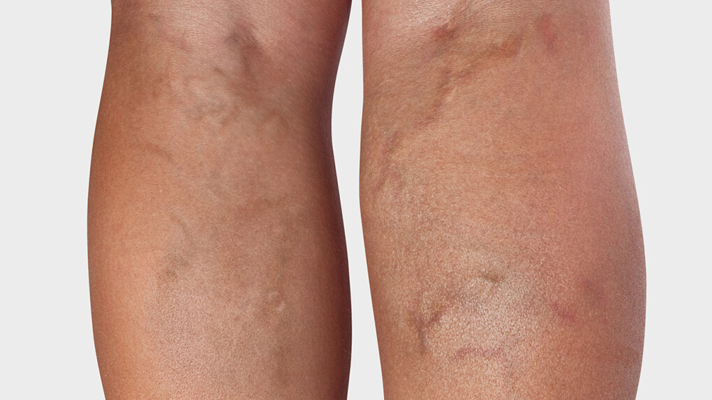 Arrière de la jambe, où l'on voit des varices Arrière de la jambe, où l'on voit des varices