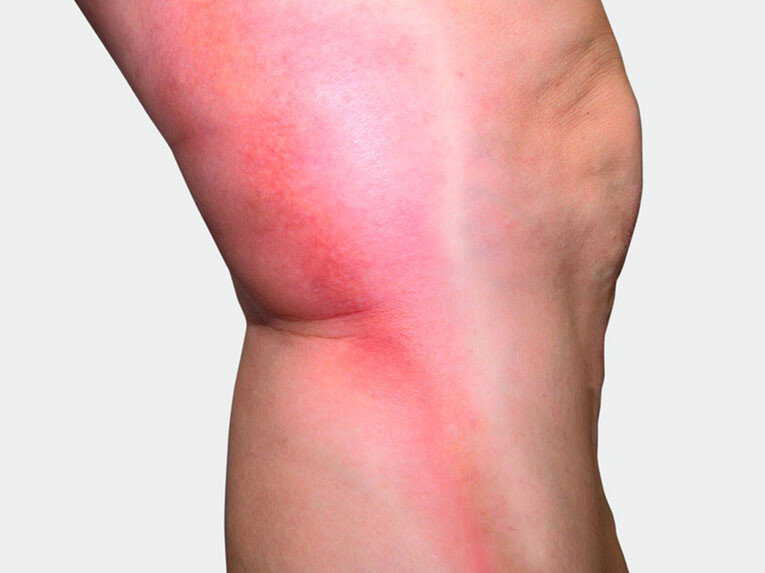 Intérieur de la jambe, où l'on observe une coloration rouge Intérieur de la jambe, où l'on observe une coloration rouge
