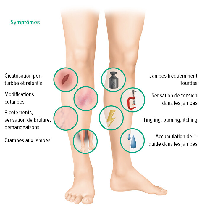 Symptômes d'une IVC Symptômes d'une IVC