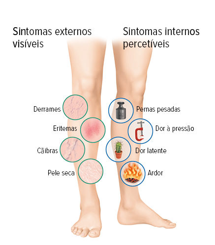Sintomas internos e externos nas pernas