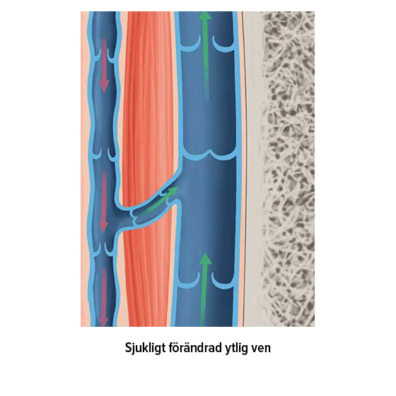 Sjukligt förändrad ytlig ven