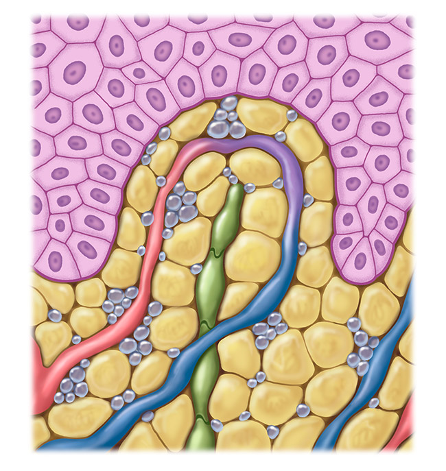 Grafik beeinträchtigtes Lymphsystem Grafik beeinträchtigtes Lymphsystem