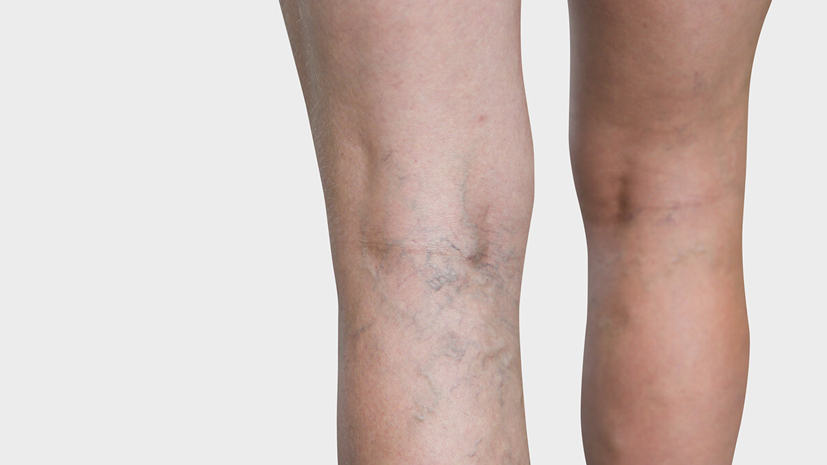 The inner side of the leg, where spider veins are visible The inner side of the leg, where spider veins are visible