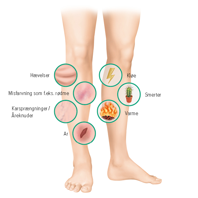 Symptomer på bensår Symptomer på bensår