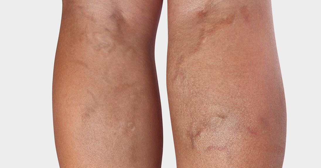 Krampfadern in den Beinen