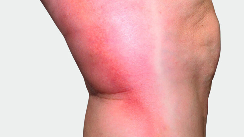L'intérieur de la jambe, où l'on observe une coloration rouge L'intérieur de la jambe, où l'on observe une coloration rouge