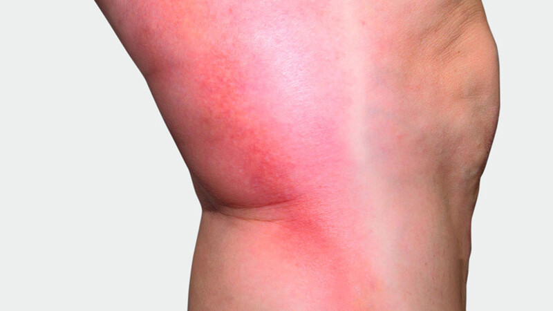L'intérieur de la jambe, où l'on observe une coloration rouge