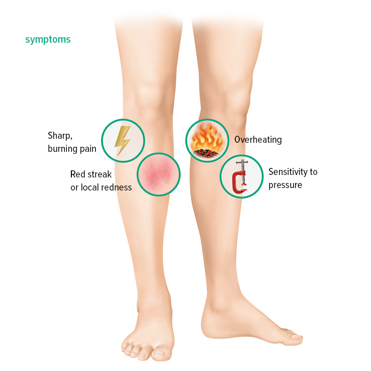Symptoms of superficial vein thrombosis Symptoms of superficial vein thrombosis