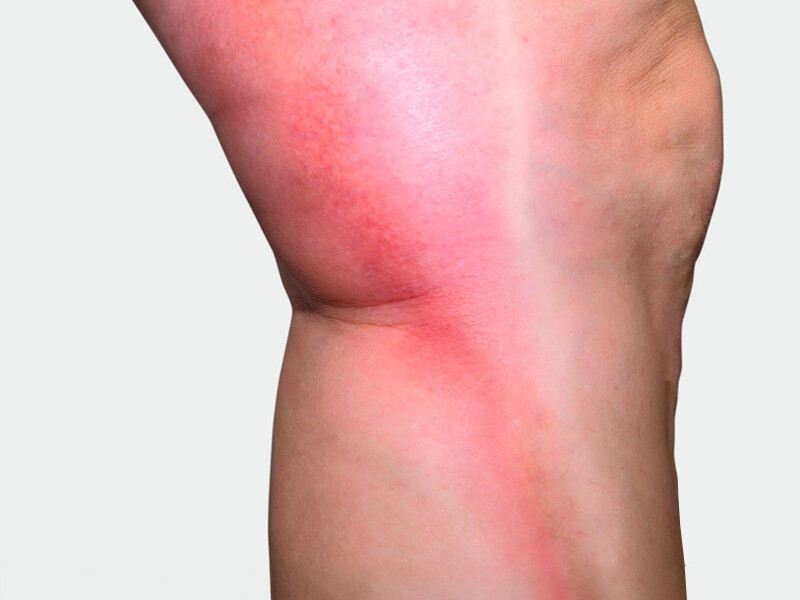 The inner side of the leg, where red discoloration is visible The inner side of the leg, where red discoloration is visible