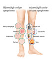 Symptomer i benene indvendigt og udvendigt
