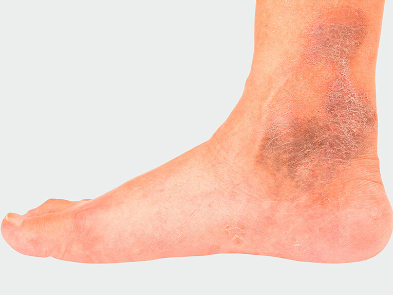 Sample image of chronic venous insufficiency