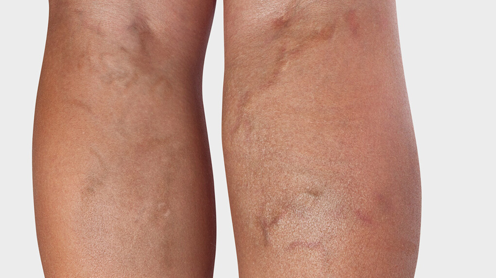 The back of the leg, where varicose veins are visible The back of the leg, where varicose veins are visible