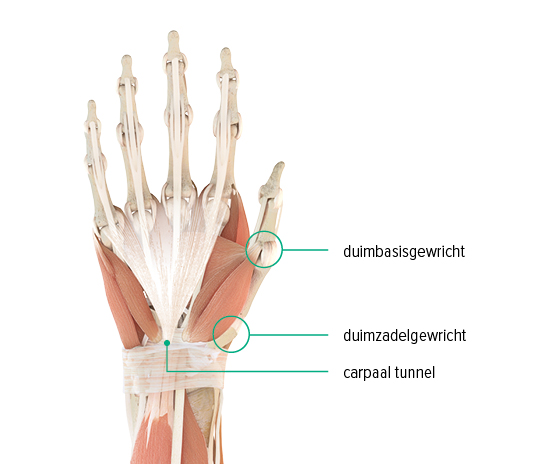 Anatomische afbeelding van een hand: hierop zijn het basale gewricht van de duim, het zadelgewricht van de duim en de locatie van de carpale tunnel te zien