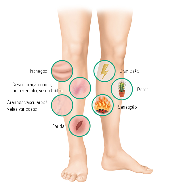 Sintomas da úlcera varicosa Sintomas da úlcera varicosa