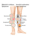 Symptome in den Beinen innerlich und äußerlich