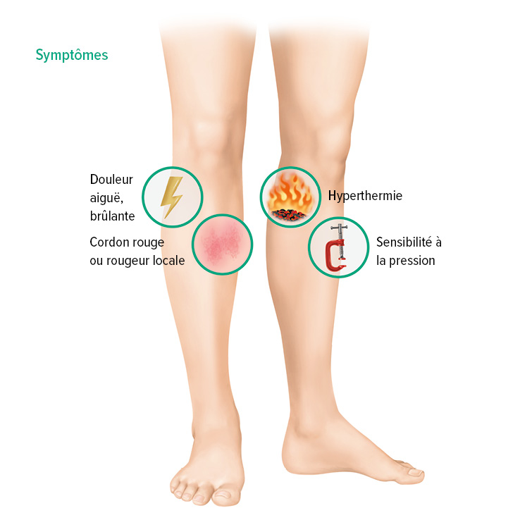 Symptômes de la thrombose veineuse superficielle