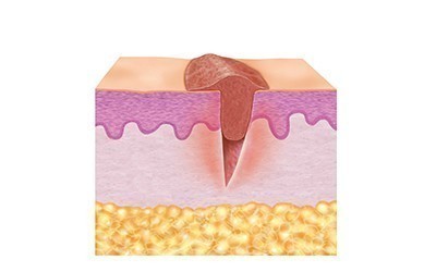 2. Nybildningsfas (proliferationsfas)