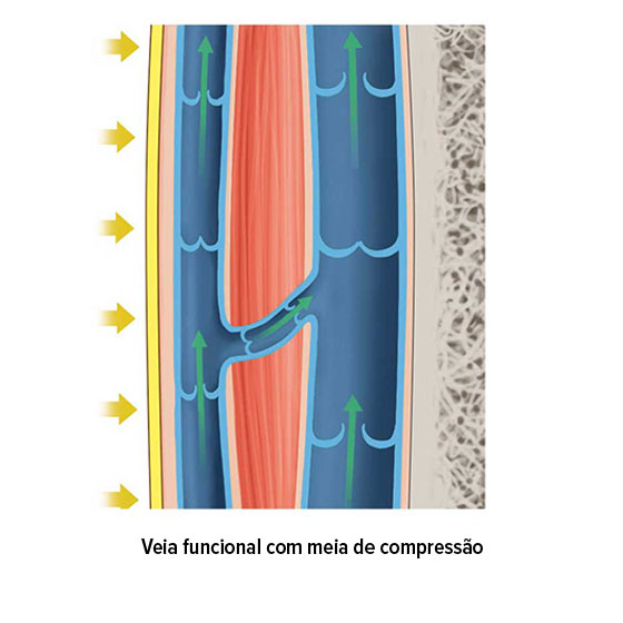 Veia funcional com meia de compressão