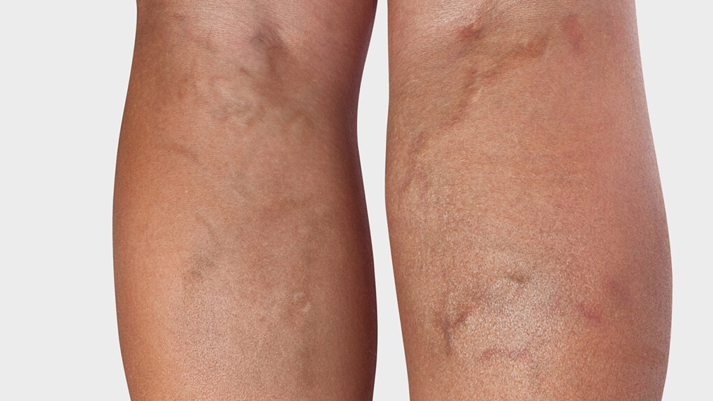 Arrière de la jambe, où l'on voit des varices Arrière de la jambe, où l'on voit des varices