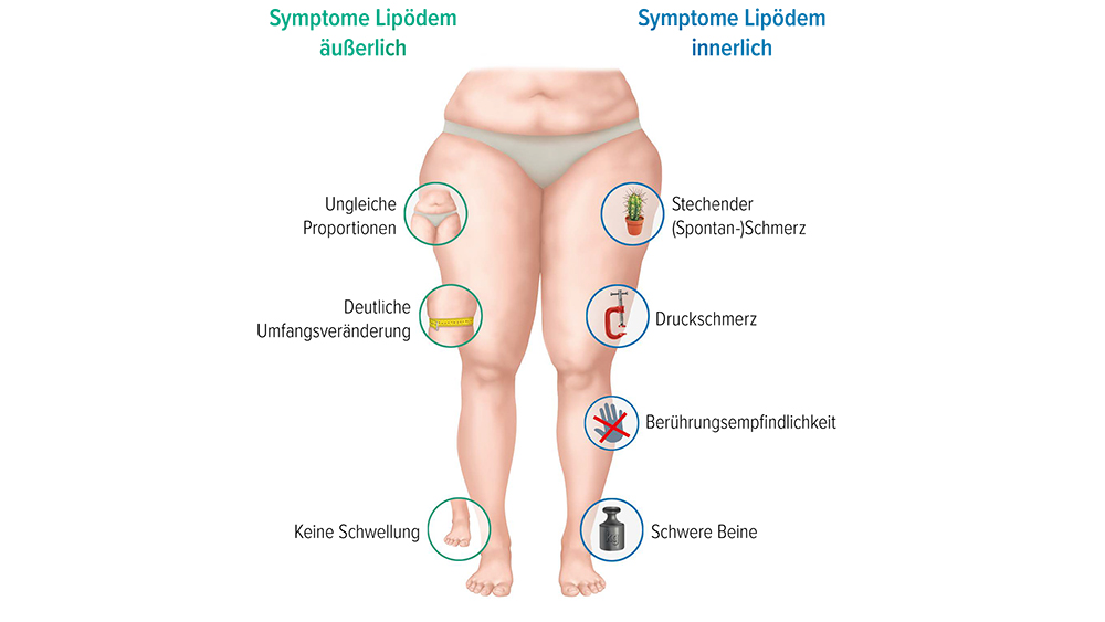 Was Ist Schlimmer Lipödem Oder Lymphödem www.juzo.com